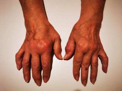 12. október je Svetovým dňom artritídy Záludná choroba napáda pohybový aparát,  jej príčinu zatiaľ nepoznáme